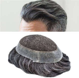 پروتز مو دور پوست
