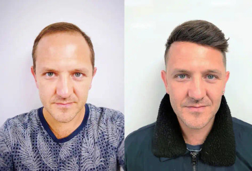 کلاه گیس بالا سری مردانه