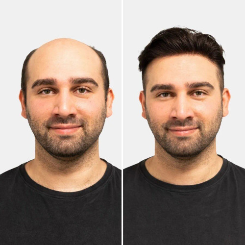 کلاه گیس بالا سر مردانه