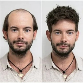 پروتز وسط سر